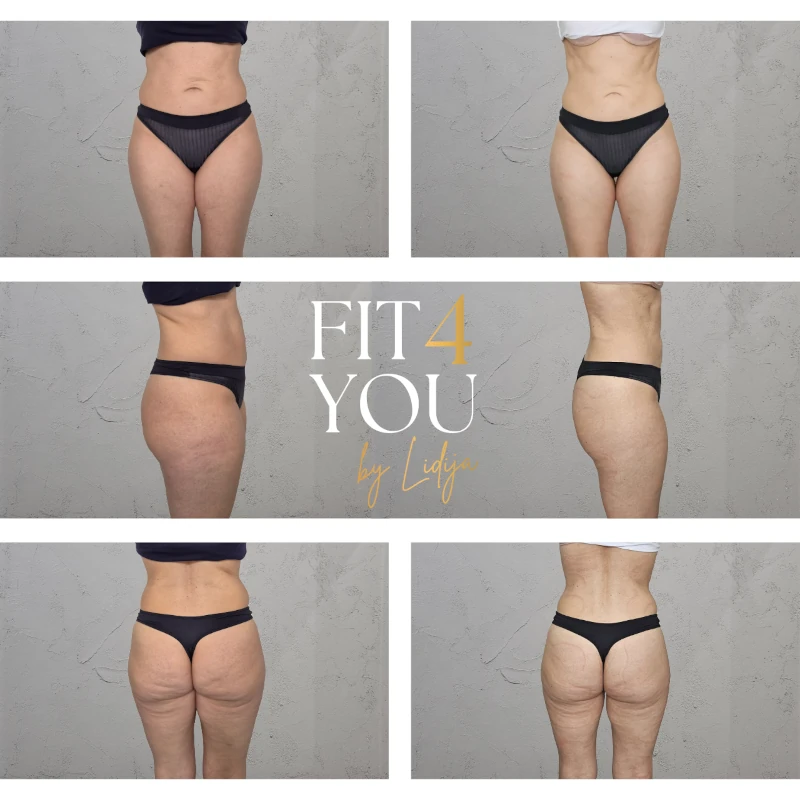 Vorher-Nachher Ergebnis 3